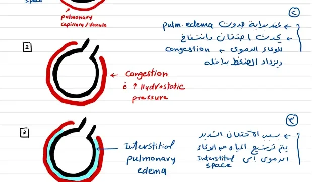 ملخص الـ pulmonary edema وعلاجها pdf