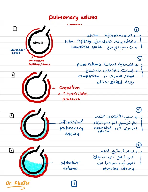 ملخص الـ pulmonary edema وعلاجها pdf